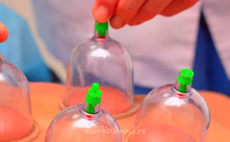 Hijama In Islam