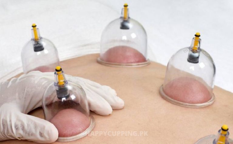 Hijama Center Near Me | Updated In 2022