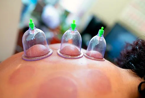 Benefits Of Dry Cupping