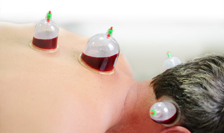 Benefits Of Wet Cupping & How It Works