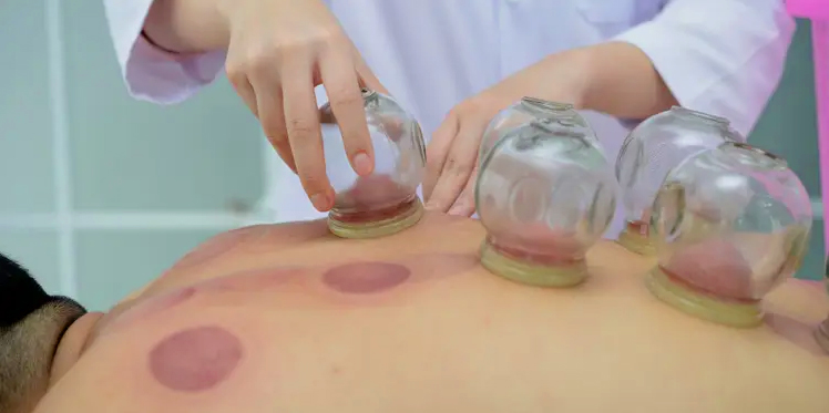 Cupping Therapy In Rawalpindi